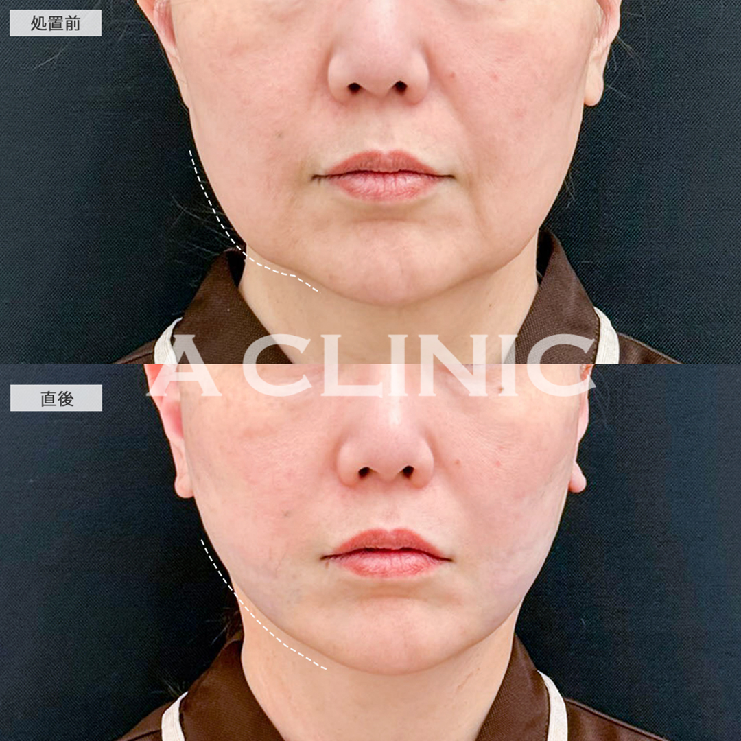 A式たるみ切開と1day小顔脂肪吸引でたるみのない輪郭になりました！こちら処置前と直後の症例です(50代女性)