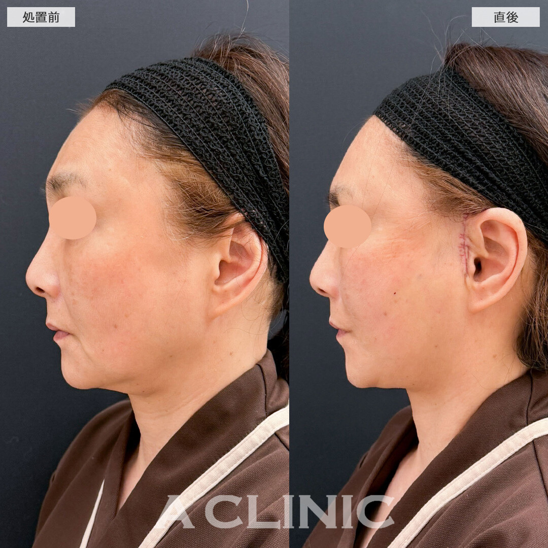 A式たるみ切開でたるみを強力に引き上げてマイナス10才見え！こちら処置前と直後の症例です(60代女性)