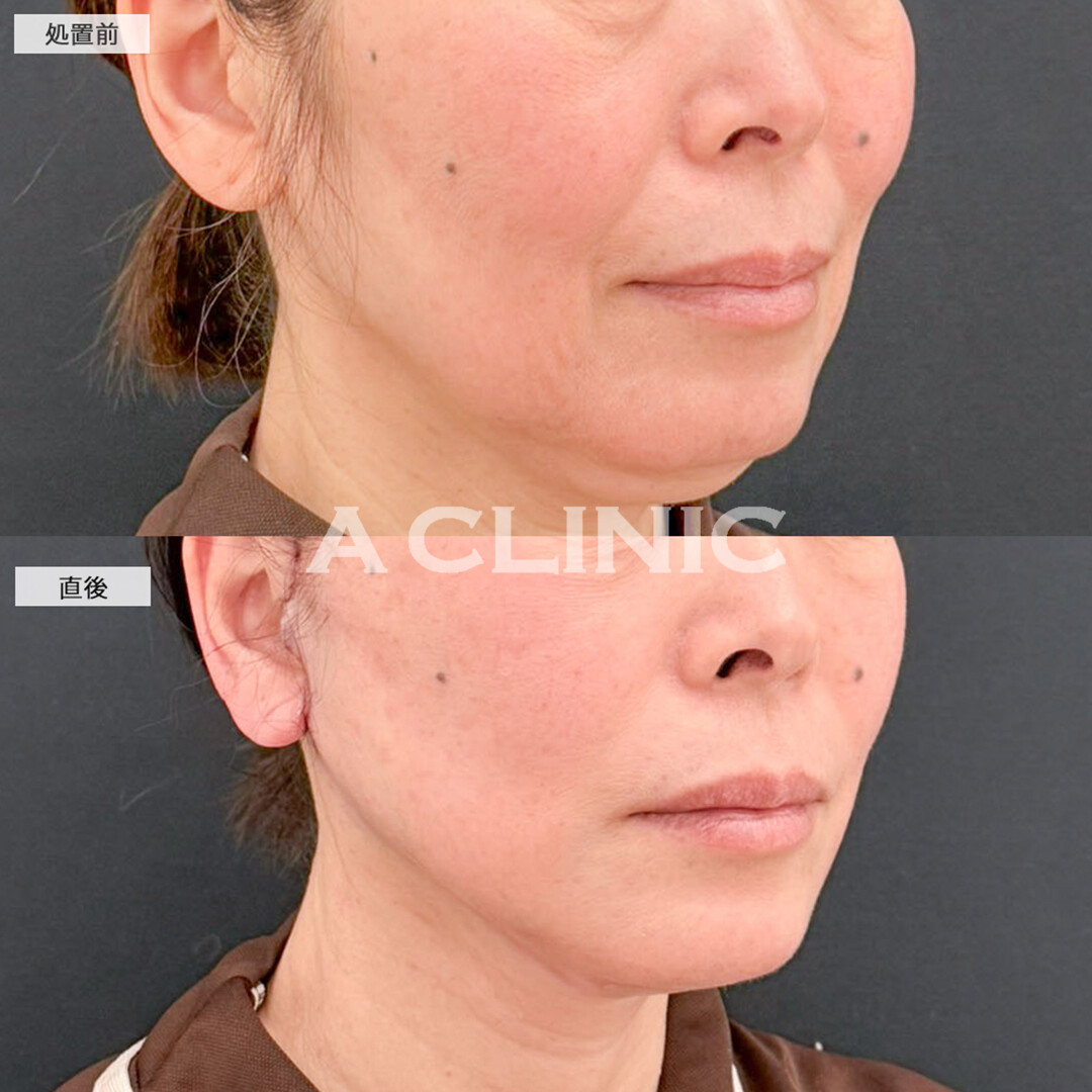 A式たるみ切開と1day小顔脂肪吸引で直後から皮膚が引きあがり二重アゴも解消され若返り！こちら処置前と直後の症例です(50代女性)