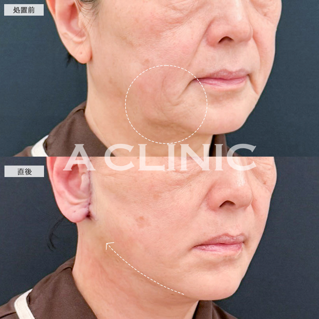 A式たるみ切開は直後からたるみが引き上がります！こちら処置前と直後の症例です(60代女性)