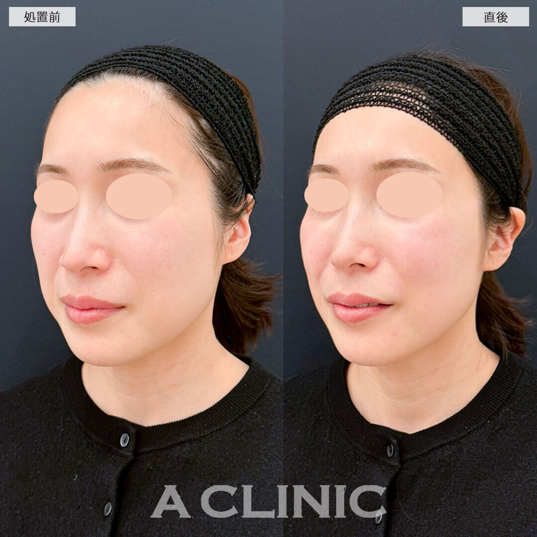 バーティカルリフトで頬のたるみがキュッと上がりました！処置前と直後の症例です(30代女性)