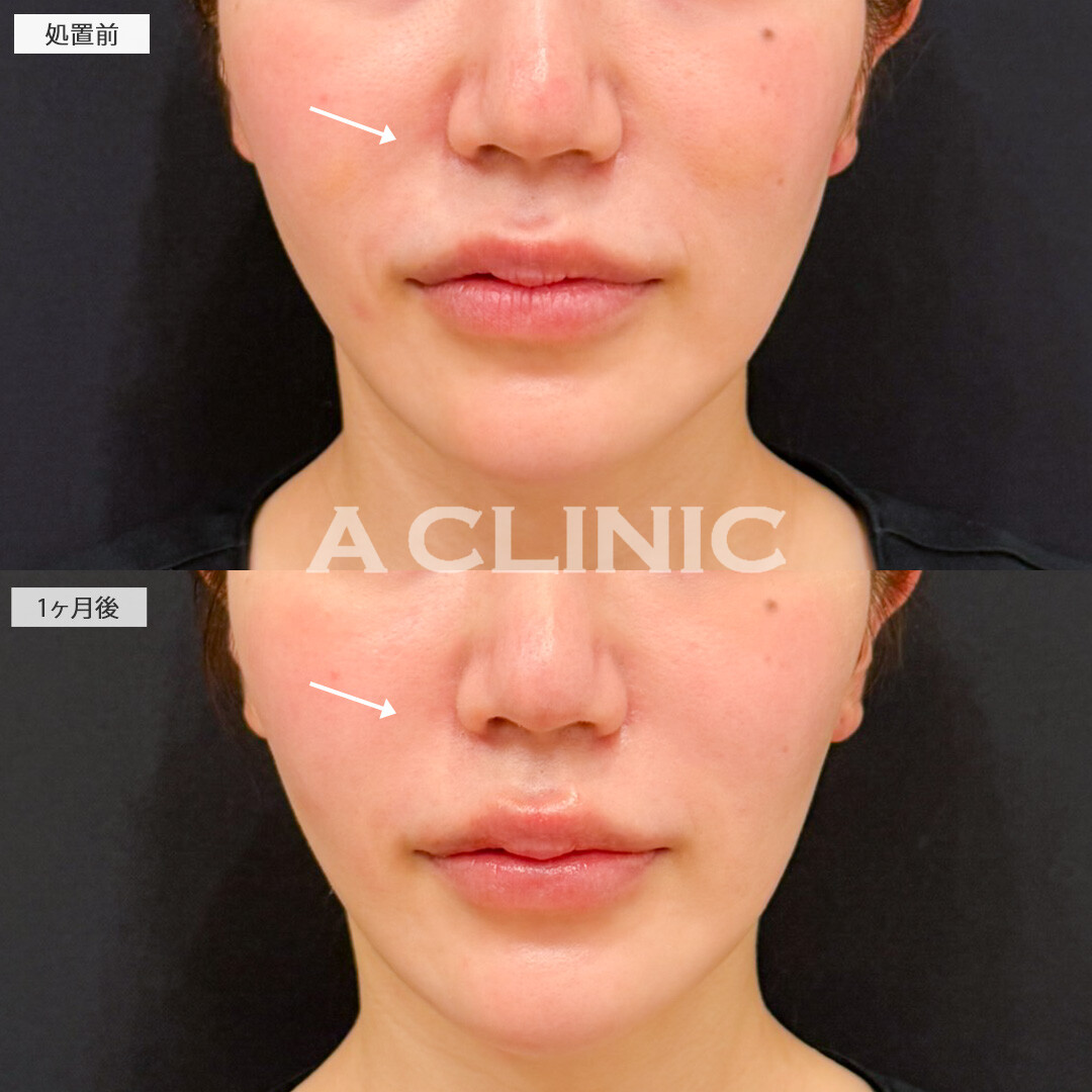 バーティカルリフトで徐々に出てくるほうれい線対策！処置前と1ヶ月後の症例です(30代女性)