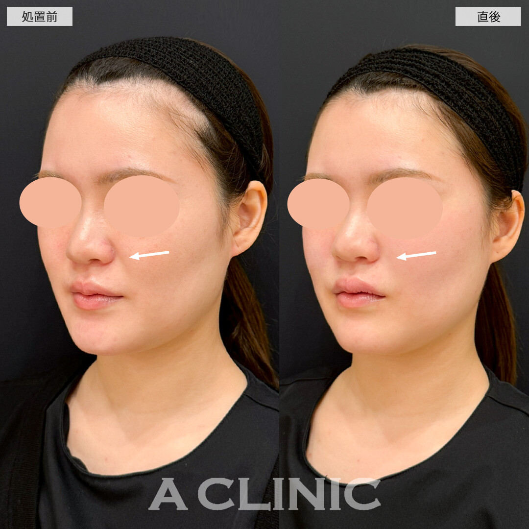 バーティカルリフトで頬がキュッと引きあがり表情もよく見えるようになりました！処置前と直後の症例です(30代女性)