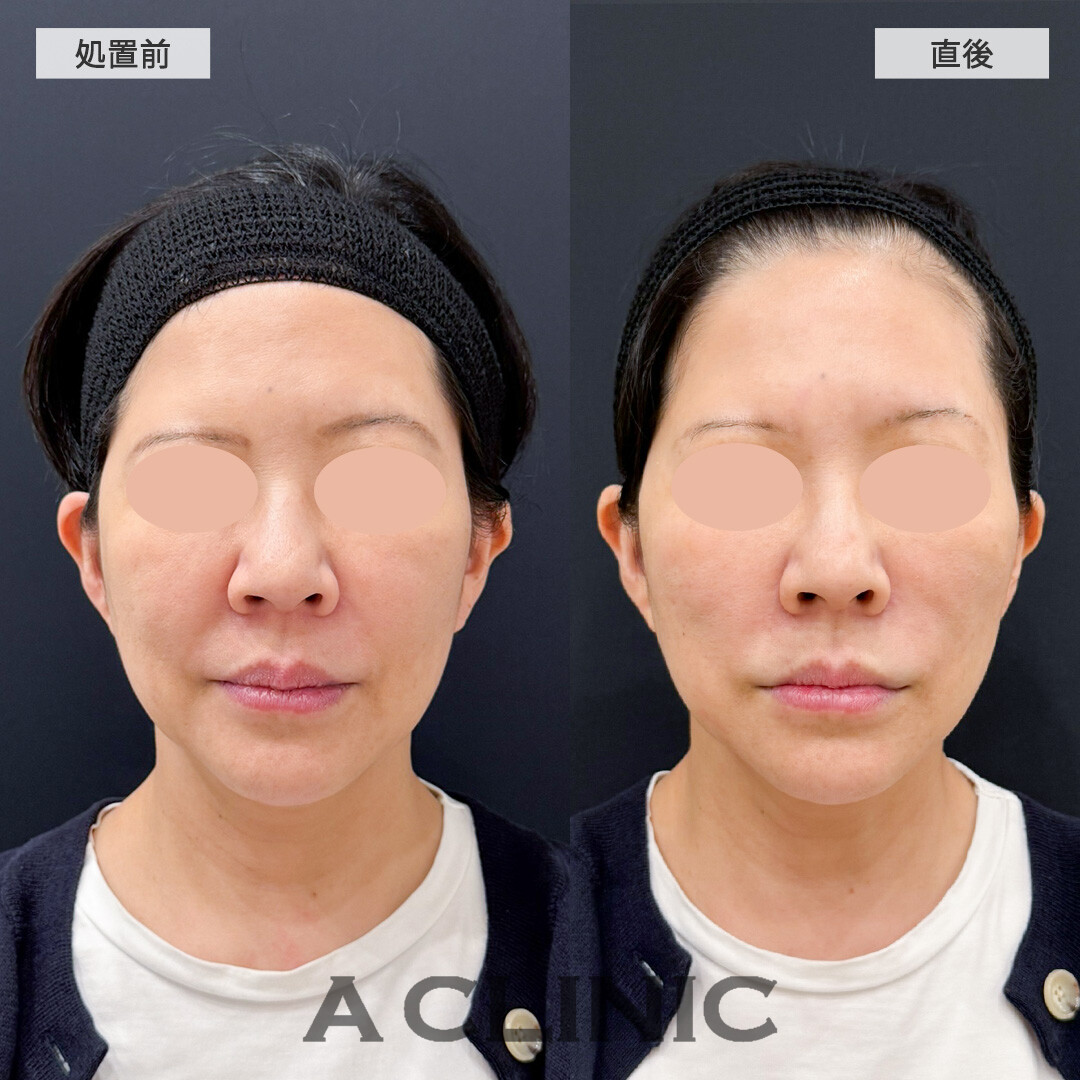 バーティカルリフトでほうれい線を改善しながら中顔面を短縮！こちらAスレッドの処置前と直後の症例です(50代女性)