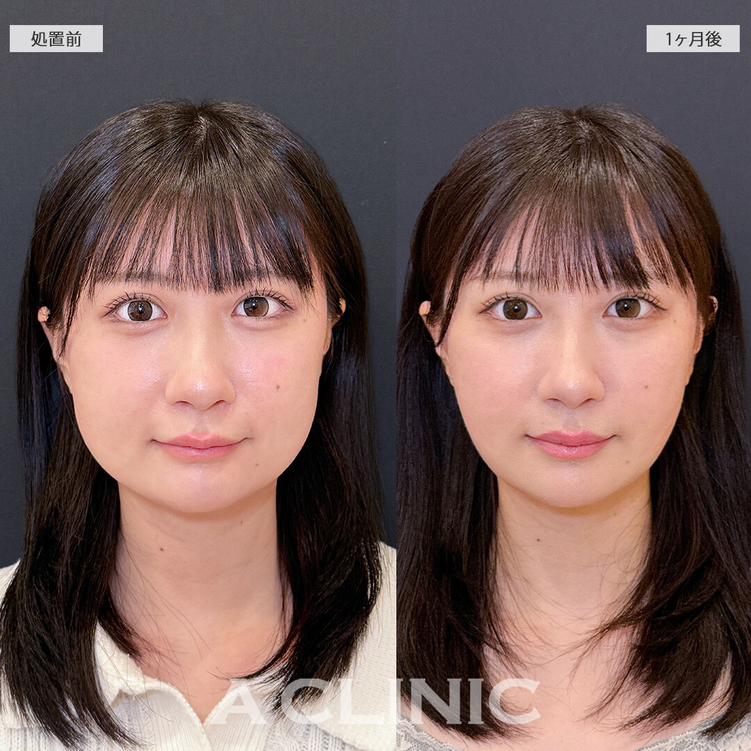 1day小顔脂肪吸引と小顔エラボトックスでひと回り小さなお顔に！処置前と1ヶ月後の症例です(20代女性)