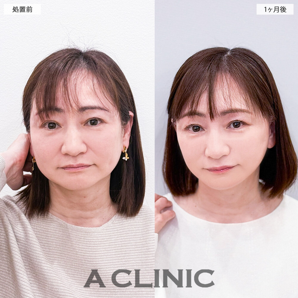 1day小顔脂肪吸引でお顔がキュッと小さくなりメイクも楽しめるようになりました！こちら処置前と1ヶ月後の症例です(50代女性)