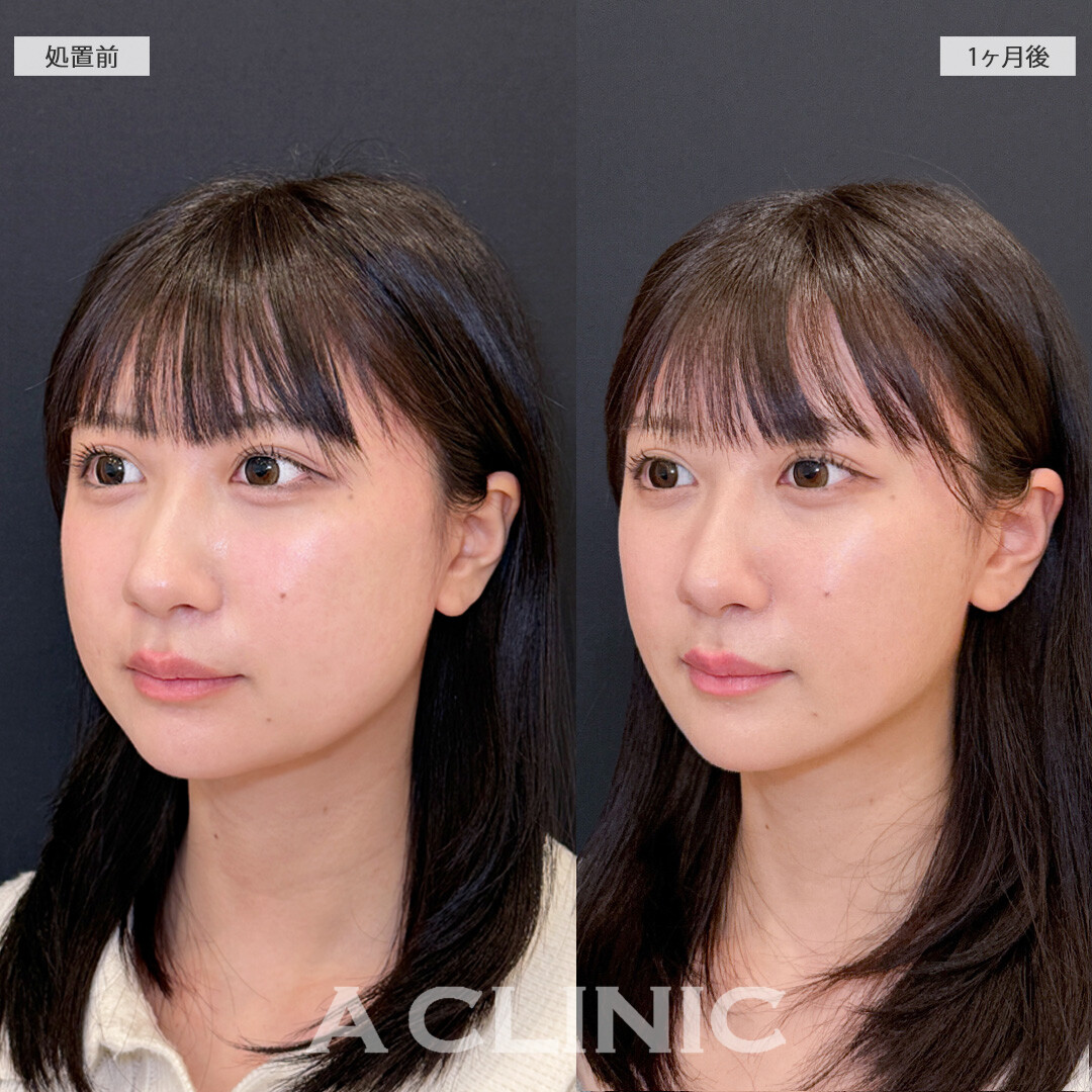 1day小顔脂肪吸引と小顔エラボトックスでひと回り小さなお顔に！処置前と1ヶ月後の症例です(20代女性)