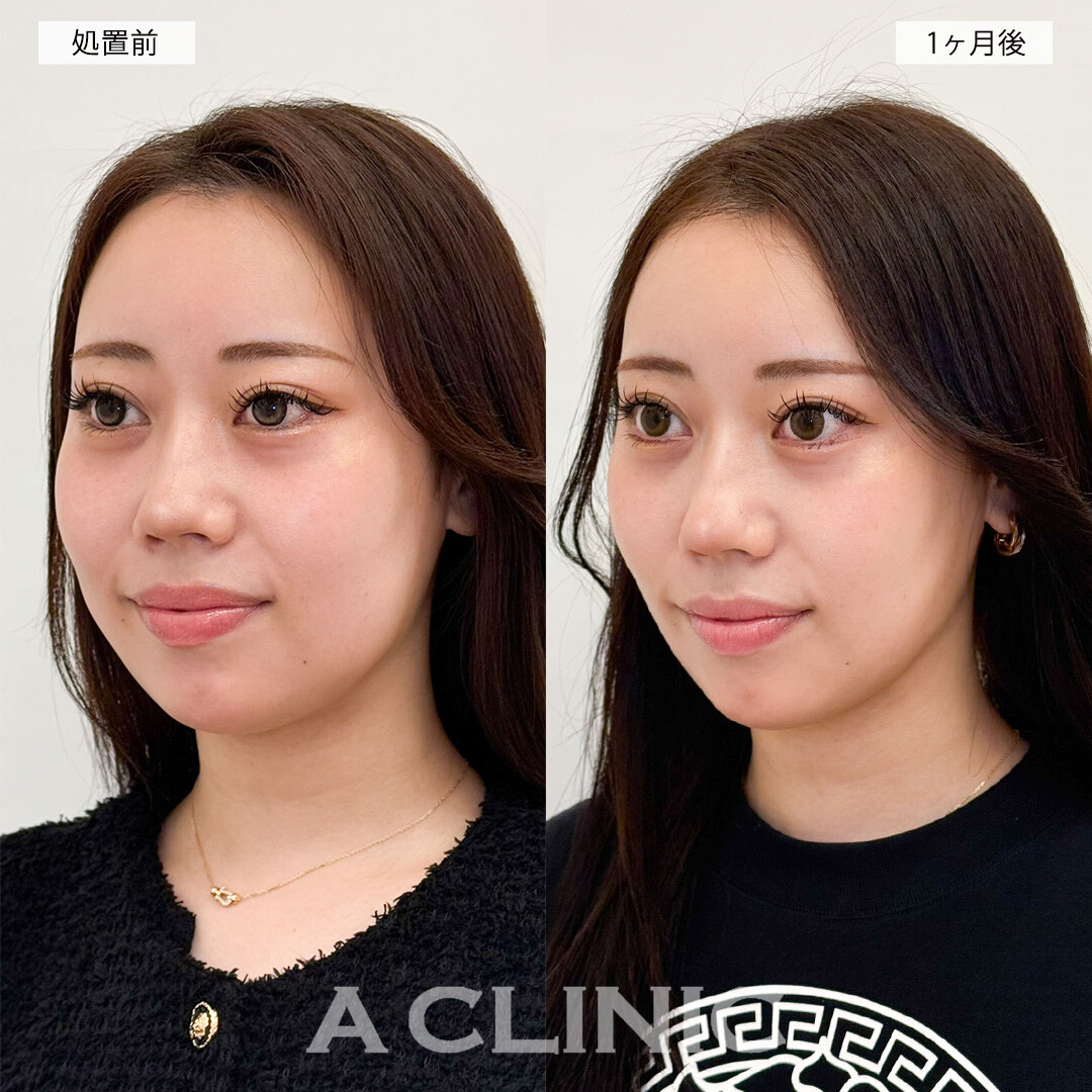 1day小顔脂肪吸引で頬の膨らみが改善されスッキリとした印象に！こちら処置前と1ヶ月後の症例です(30代女性)