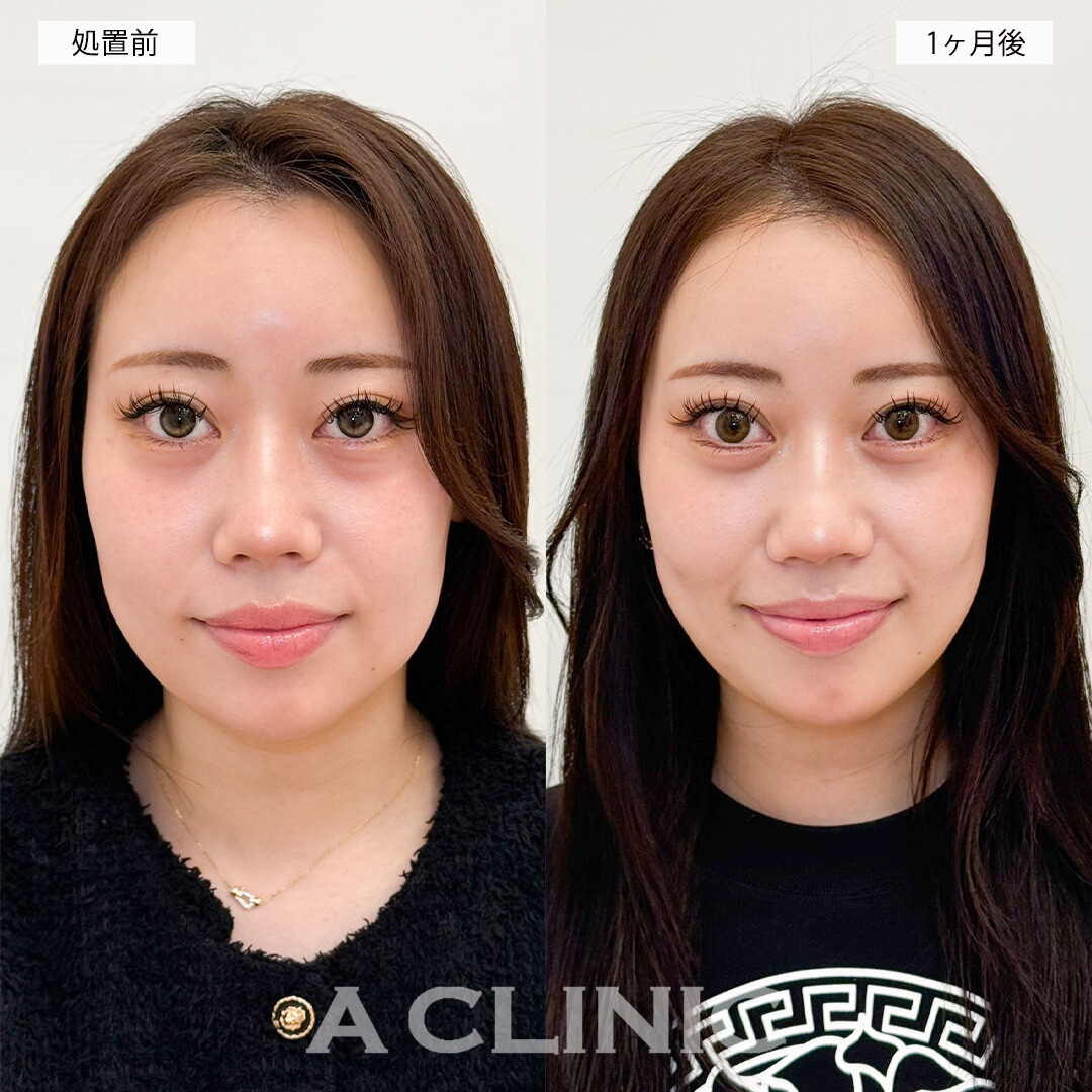 1day小顔脂肪吸引で頬の膨らみが改善されスッキリとした印象に！こちら処置前と1ヶ月後の症例です(30代女性)