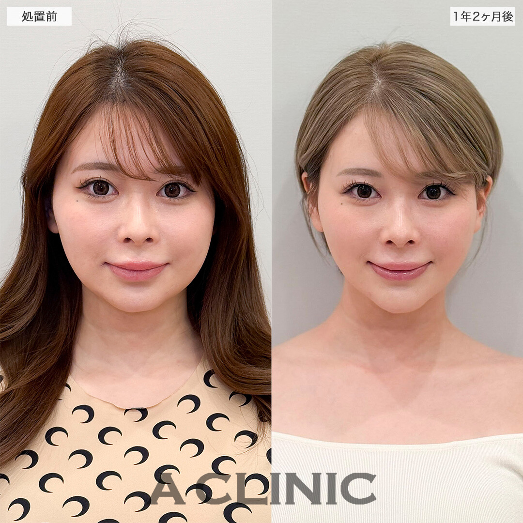 1day小顔脂肪吸引で1年以上経っても後戻り無し！処置前と1年2ヶ月後の症例です(20代女性)