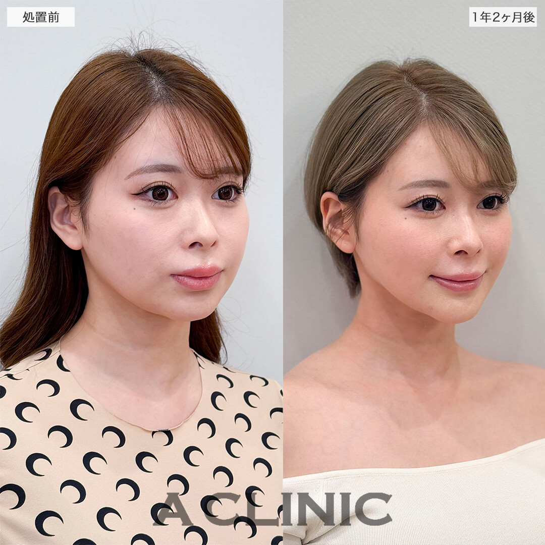 1day小顔脂肪吸引で1年以上経っても後戻り無し！処置前と1年2ヶ月後の症例です(20代女性)