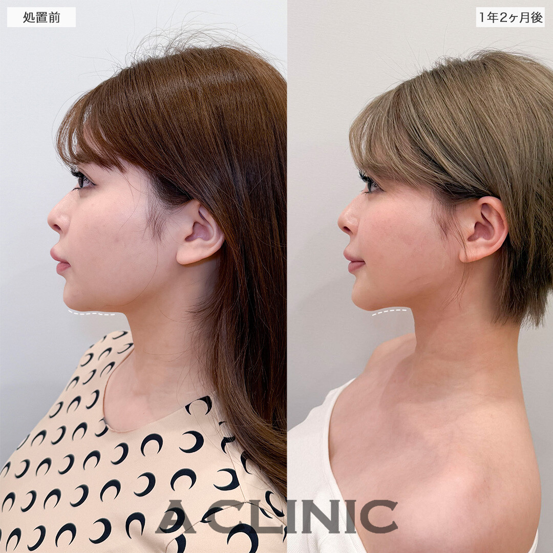 1day小顔脂肪吸引で1年以上経っても後戻り無し！処置前と1年2ヶ月後の症例です(20代女性)