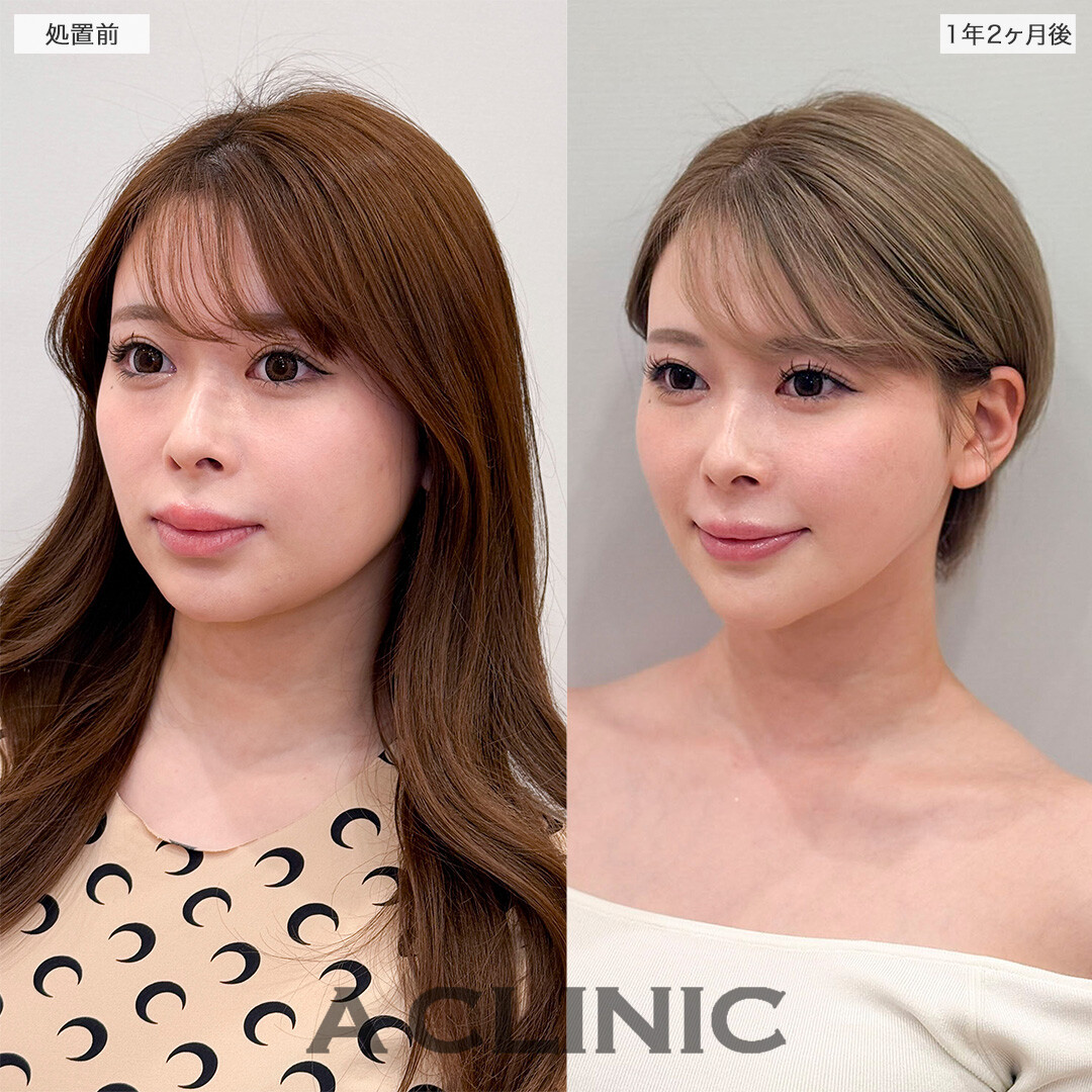 1day小顔脂肪吸引で1年以上経っても後戻り無し！処置前と1年2ヶ月後の症例です(20代女性)