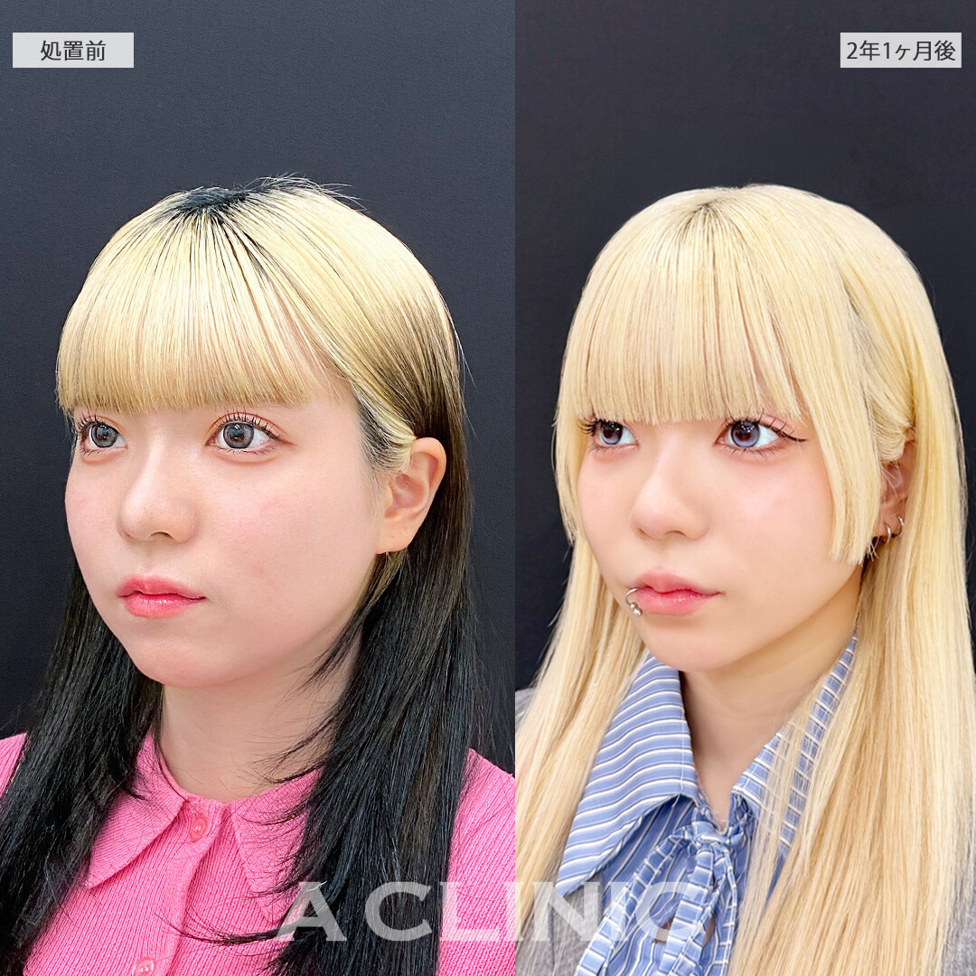 時間が経っても美しい小顔をキープできます！1day小顔脂肪吸引の処置前と2年1ヶ月後の症例です(20代女性)