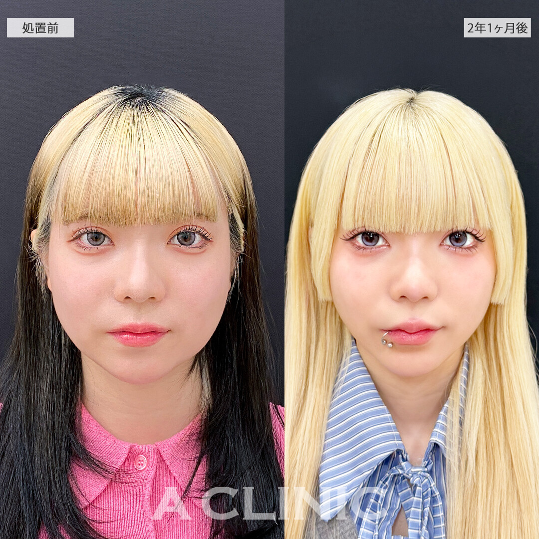時間が経っても美しい小顔をキープできます！1day小顔脂肪吸引の処置前と2年1ヶ月後の症例です(20代女性)