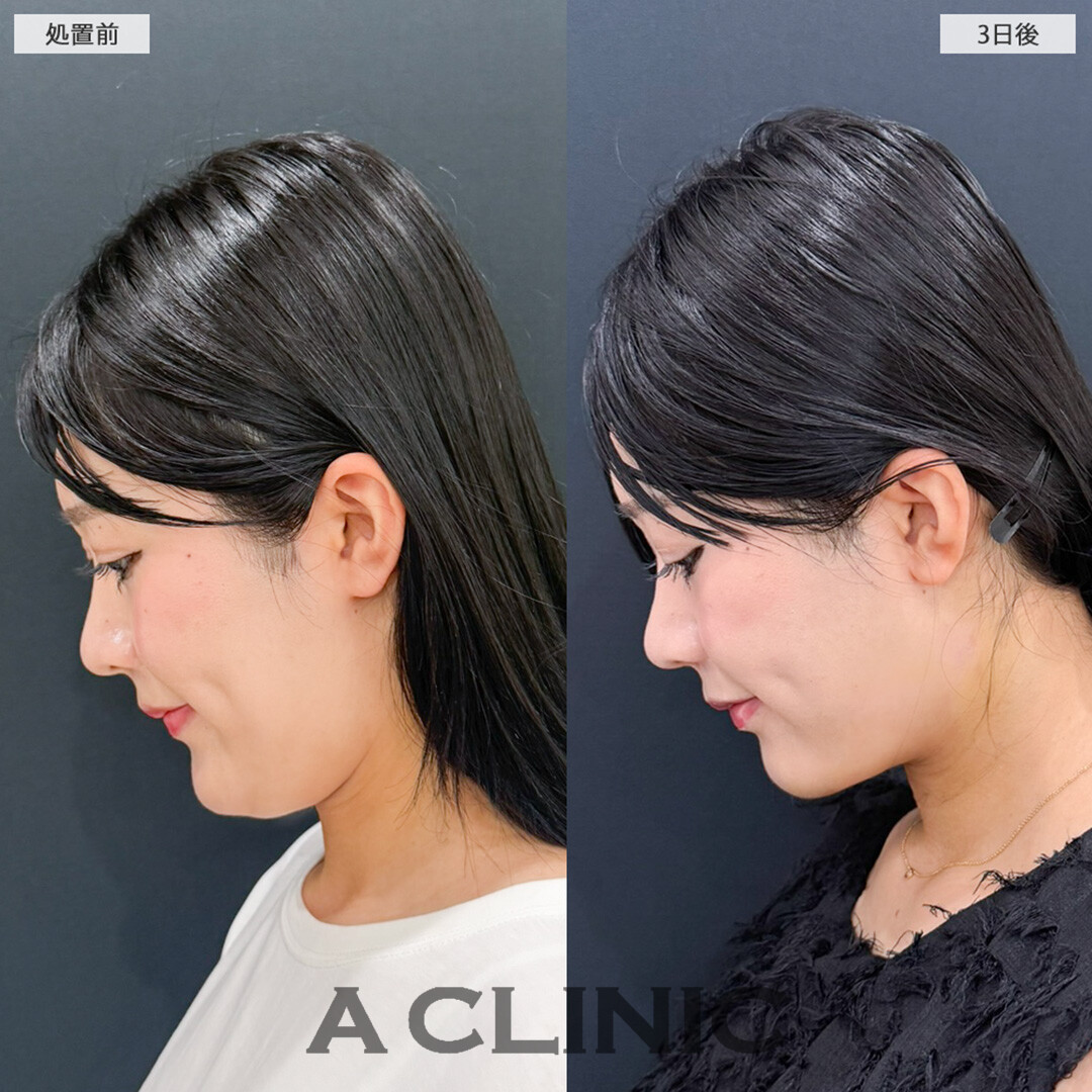 1day小顔脂肪吸引で理想のすっきりフェイスラインに！こちら処置前と3日後後の症例です(20代女性)