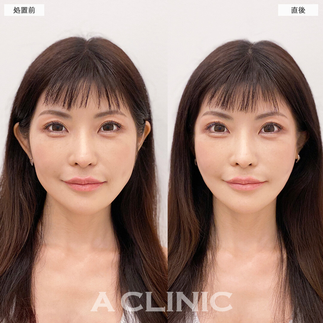 Aスレッドは腫れ最小限なので即日で輪郭が整います！処置前と直後の症例です(30代女性)