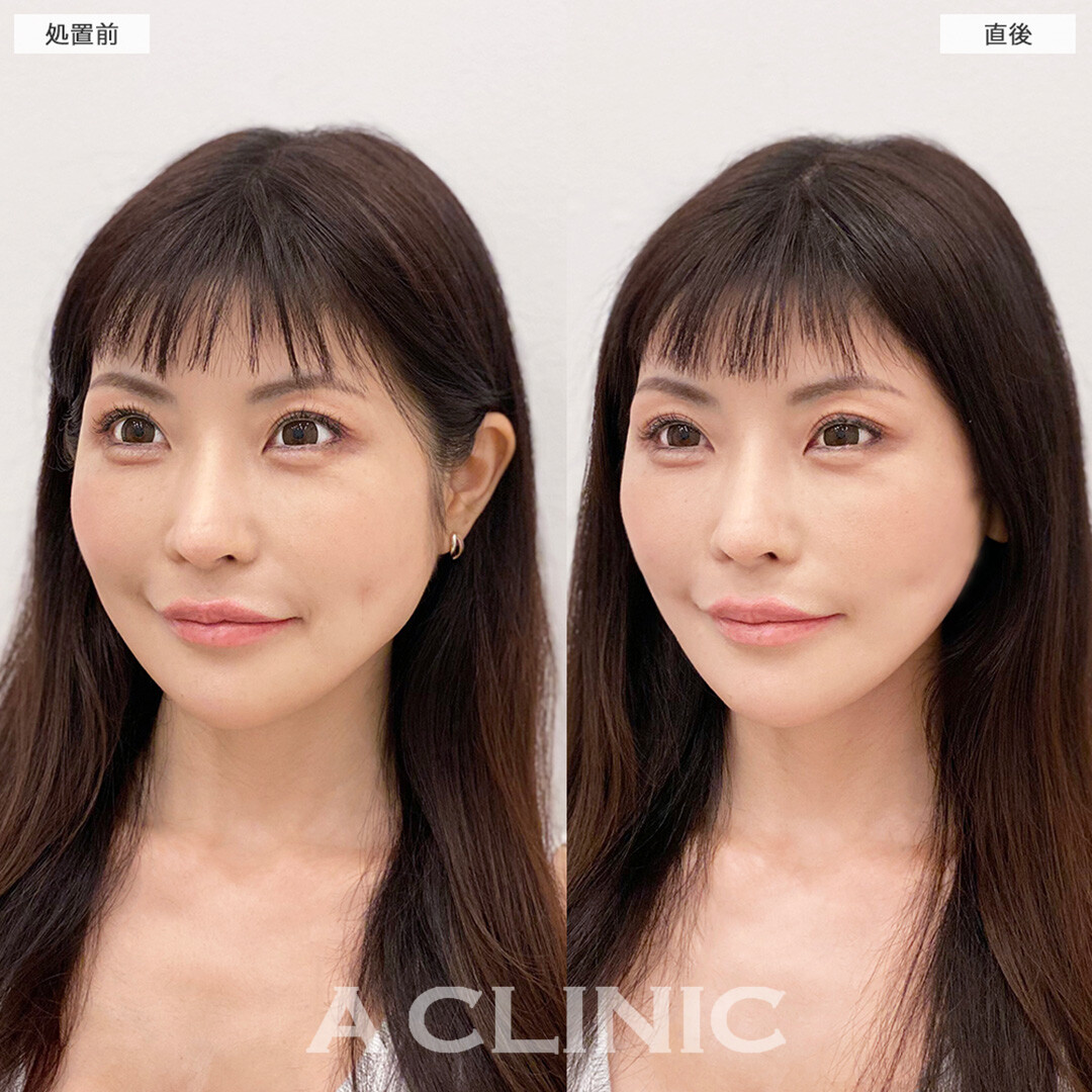 Aスレッドは腫れ最小限なので即日で輪郭が整います！処置前と直後の症例です(30代女性)