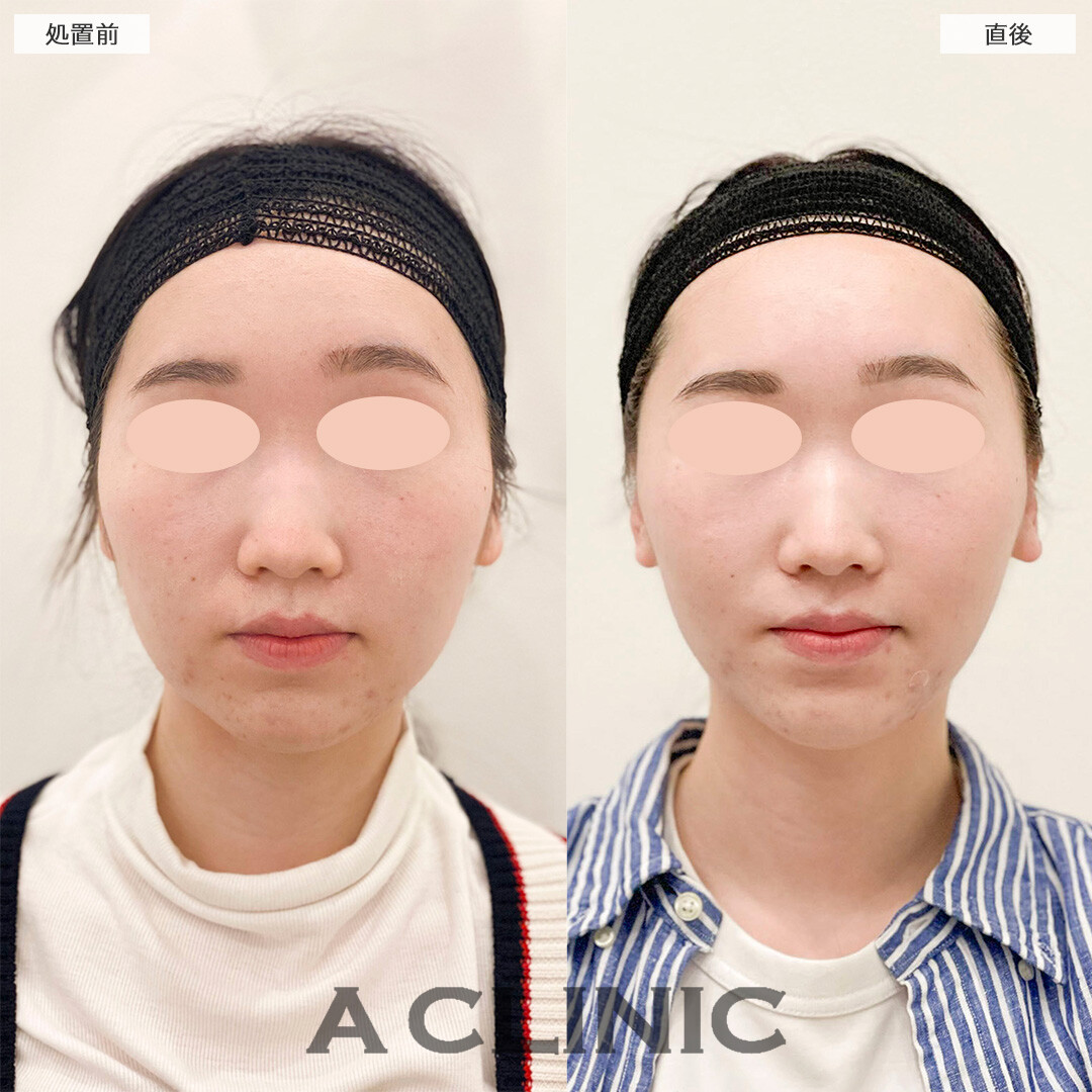 Aスレッドで加工無しでも盛れるVフェイスになりました！処置前と直後の症例です(20代女性)