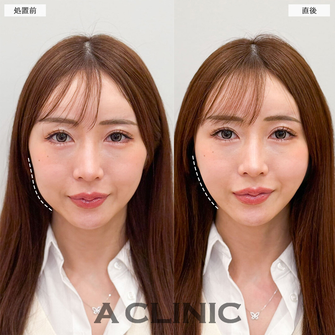 Aスレッドで輪郭の左右差を解消し即リフトアップ！こちら処置前と直後の症例です(30代女性)