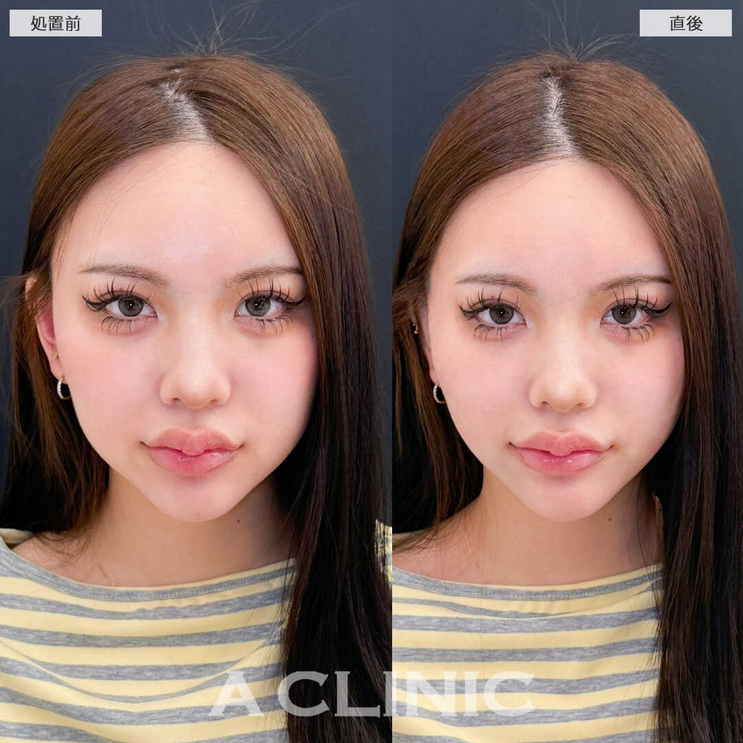 Aスレッドで口横のもたつきを持ち上げて小顔美人に！こちら処置前と直後の症例です(20代女性)