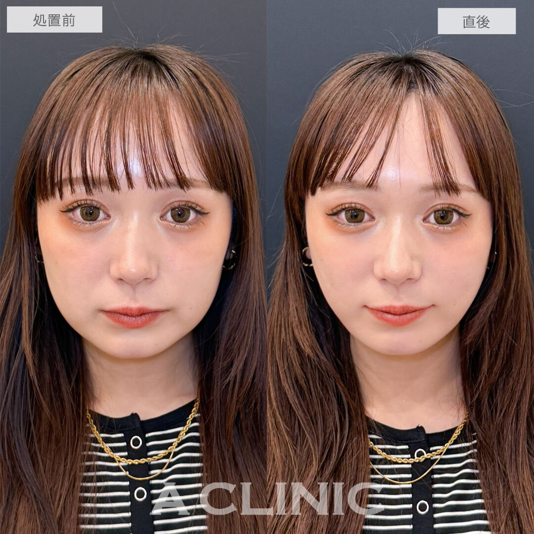 Aスレッドで即日スッキリVフェイスになりました！こちら処置前と直後の症例です(20代女性)