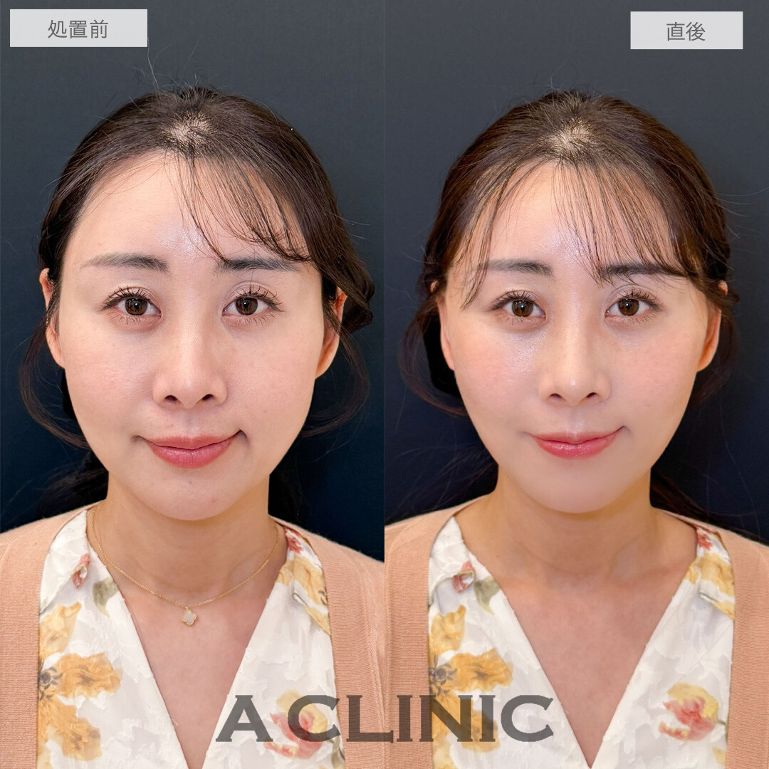 Aスレッドでたるみに一撃！１５分後若返り達成しました。こちら処置前と直後の症例です(40代女性)