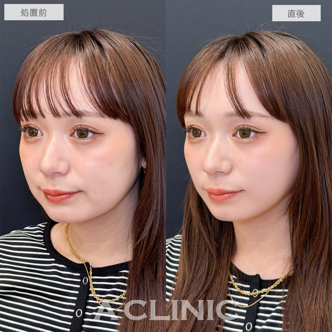 Aスレッドで即日スッキリVフェイスになりました！こちら処置前と直後の症例です(20代女性)