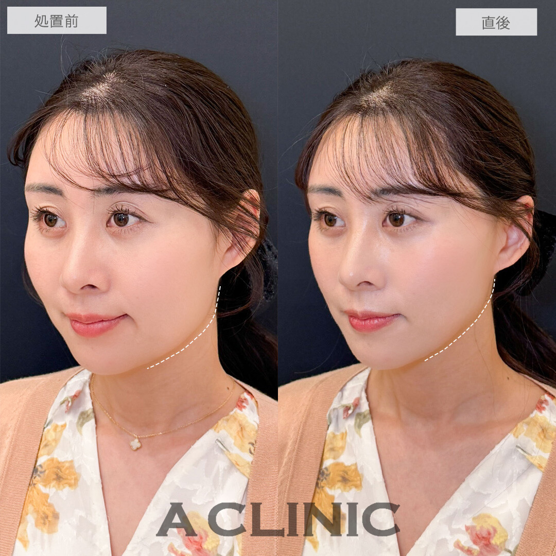 Aスレッドでたるみに一撃！１５分後若返り達成しました。こちら処置前と直後の症例です(40代女性)
