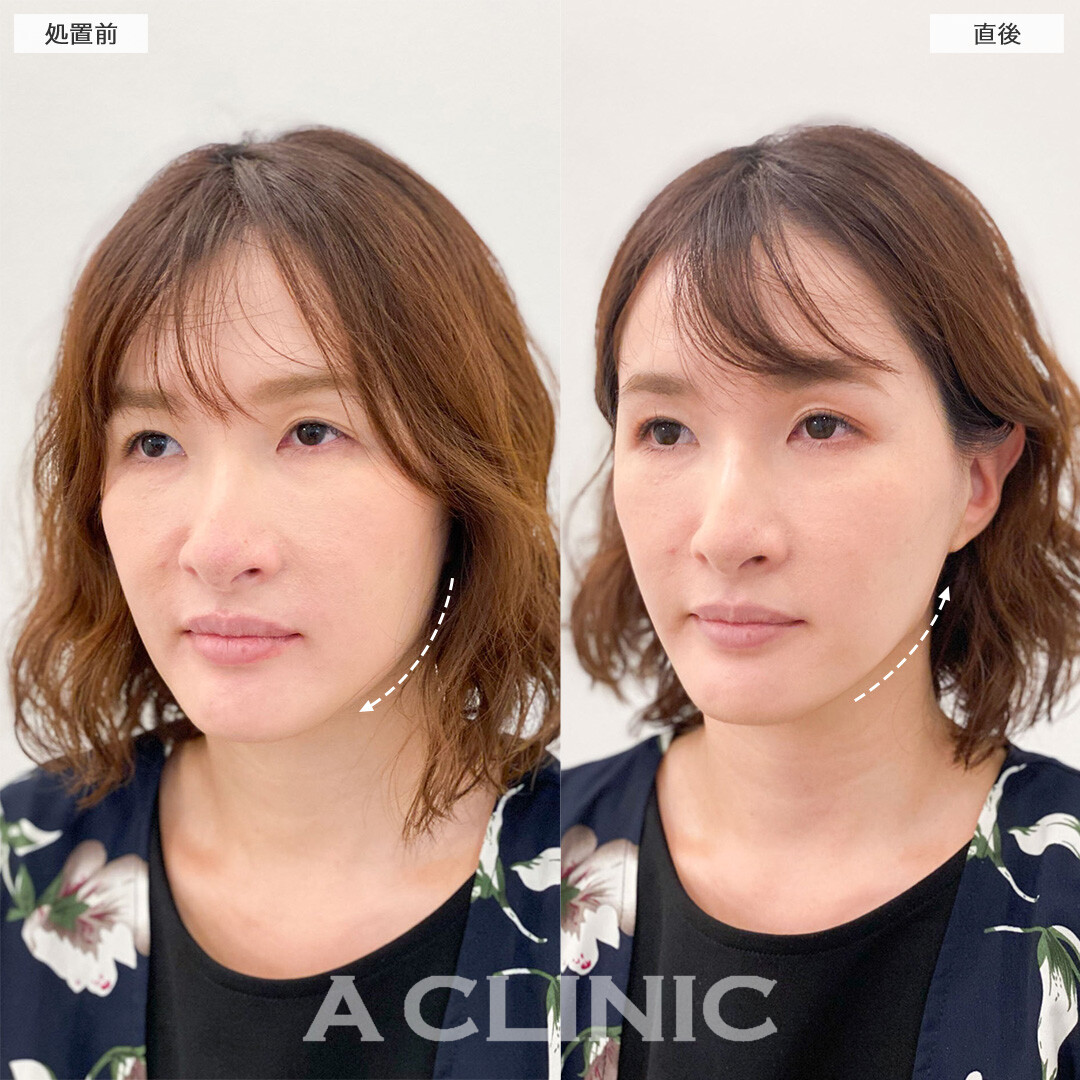 Aスレッドで下顔面のもたつきを解消し若返りに成功しました！こちら処置前と直後の症例です(30代女性)
