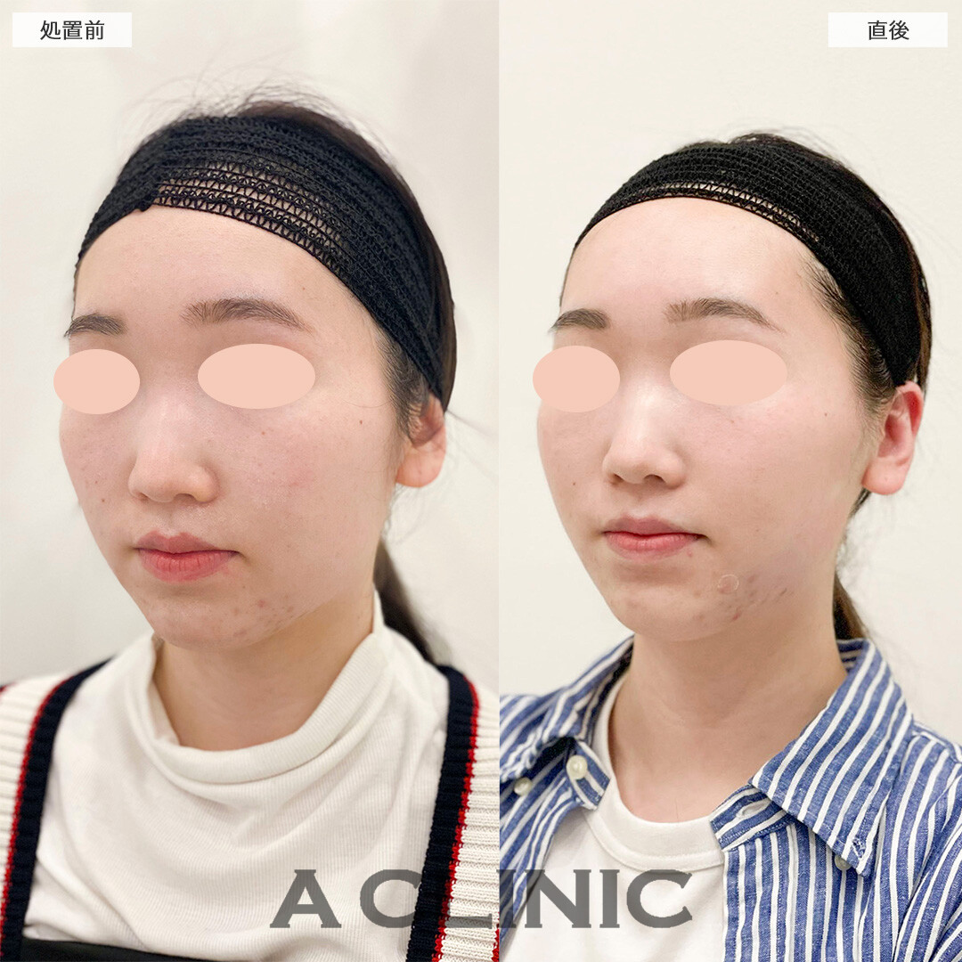 Aスレッドで加工無しでも盛れるVフェイスになりました！処置前と直後の症例です(20代女性)