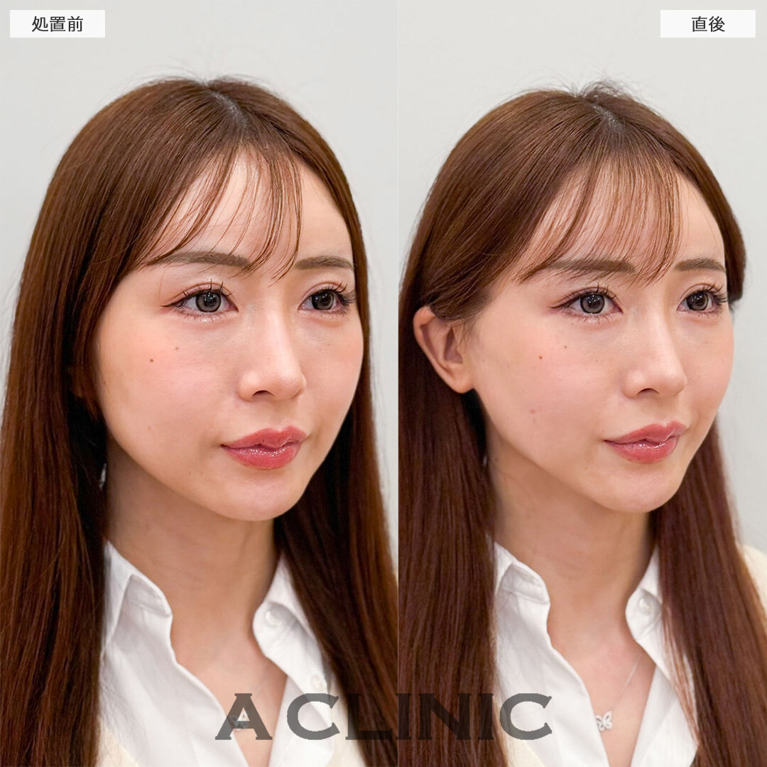 Aスレッドで輪郭の左右差を解消し即リフトアップ！こちら処置前と直後の症例です(30代女性)