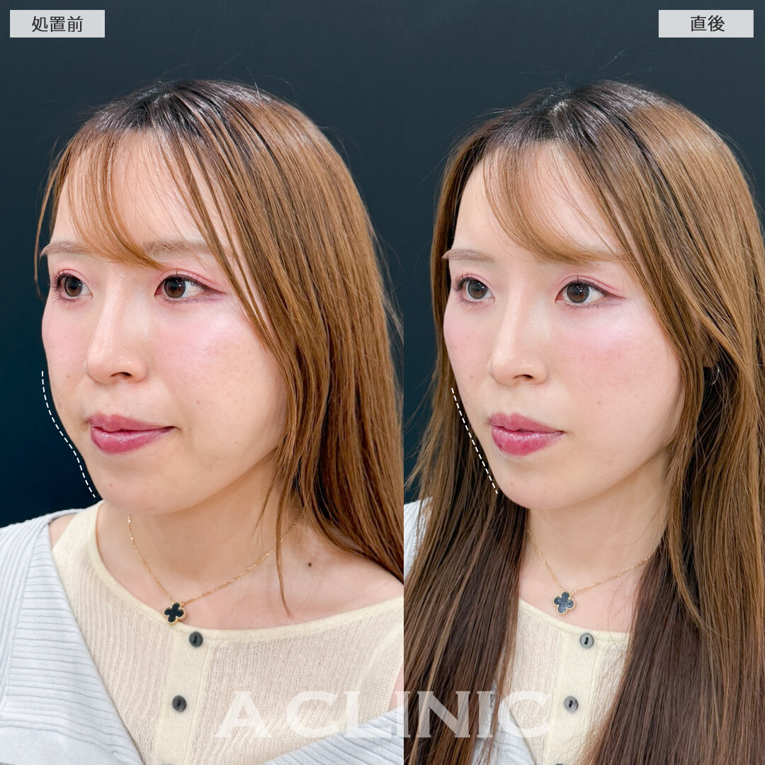 Aスレッドでもたつきも凹つきも1日で同時に解消できて時間がない方にもおすすめ！処置前と直後の症例です(30代女性)
