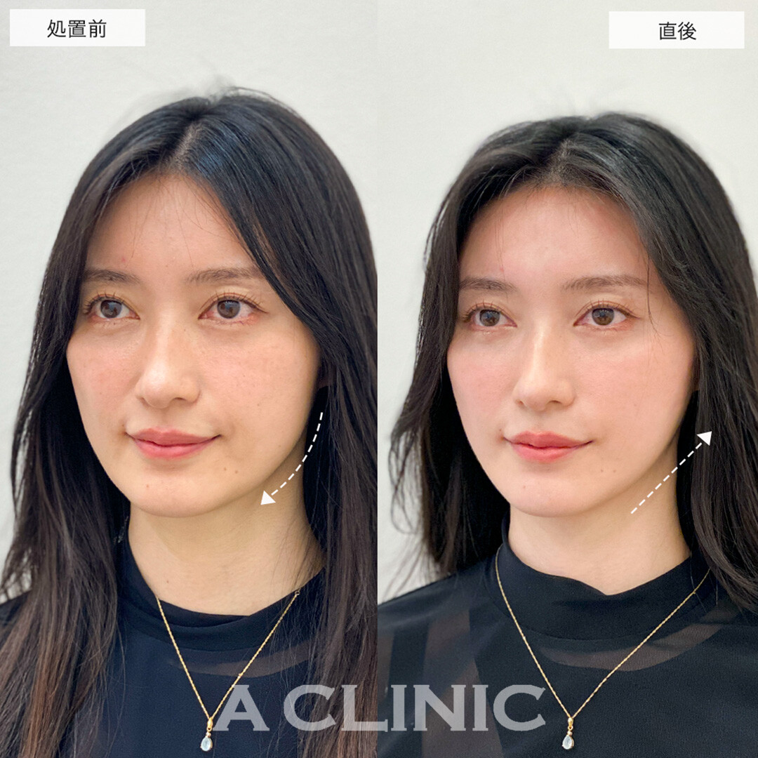 Aスレッドでフェイスラインのもたつきを解消し理想の輪郭に!こちら処置前と直後の症例です(30代女性)