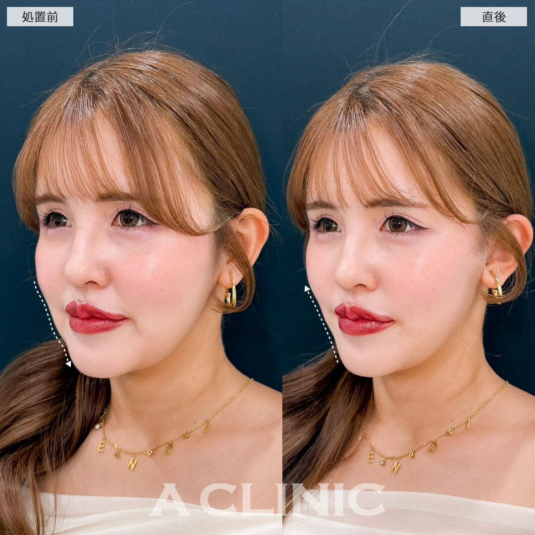 Aスレッドでゆるみ始めた輪郭をシャープに再構築しほうれい線も怖くない無敵の輪郭に！こちら処置前と直後の症例です(30代女性)