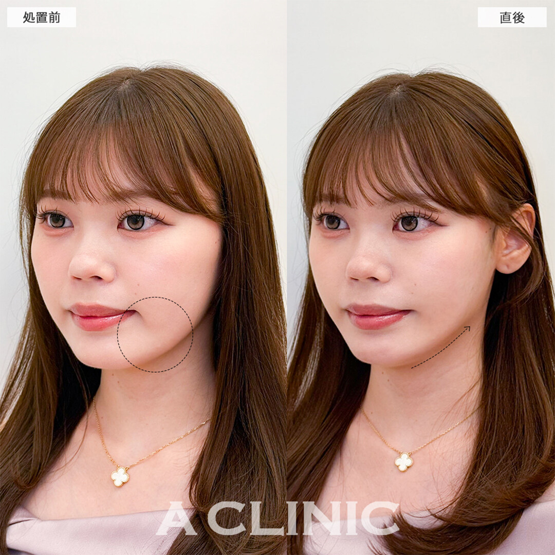 Aスレッドで可愛いお顔が更に可愛くなりました！こちら処置前と直後の症例です(20代女性)