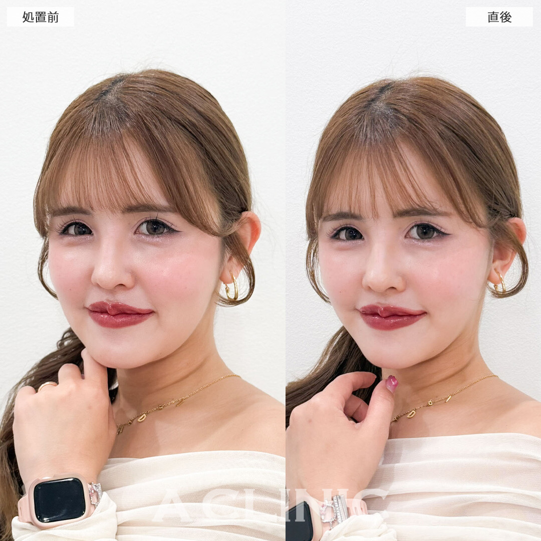 Aスレッドでゆるみ始めた輪郭をシャープに再構築しほうれい線も怖くない無敵の輪郭に！こちら処置前と直後の症例です(30代女性)