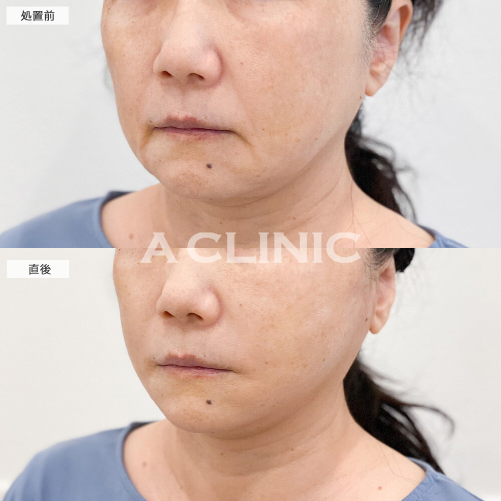Aスレッドでお顔の全体的なたるみが改善し、疲れ顔が解消しました！こちら処置前と直後の症例です(50代女性)