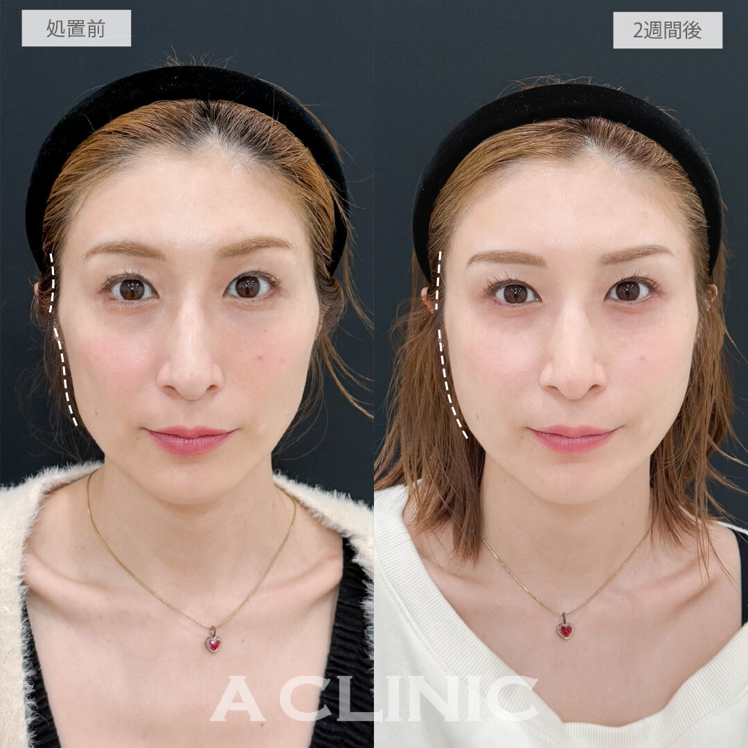 ヒアルロン酸カスタマイズメニューで凹凸やコケがなくなり健康的で若々しい印象に！処置前と2週間後の症例です(30代女性)