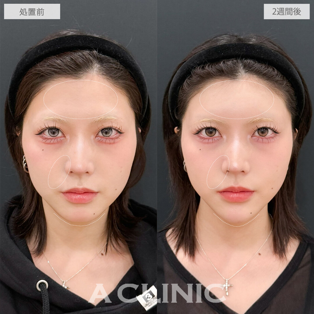 ヒアルロン酸カスタマイズメニューで作る丸いおでこと黄金比Eラインで全方位無敵のお顔に！こちら処置前と2週間後の症例です(20代女性)
