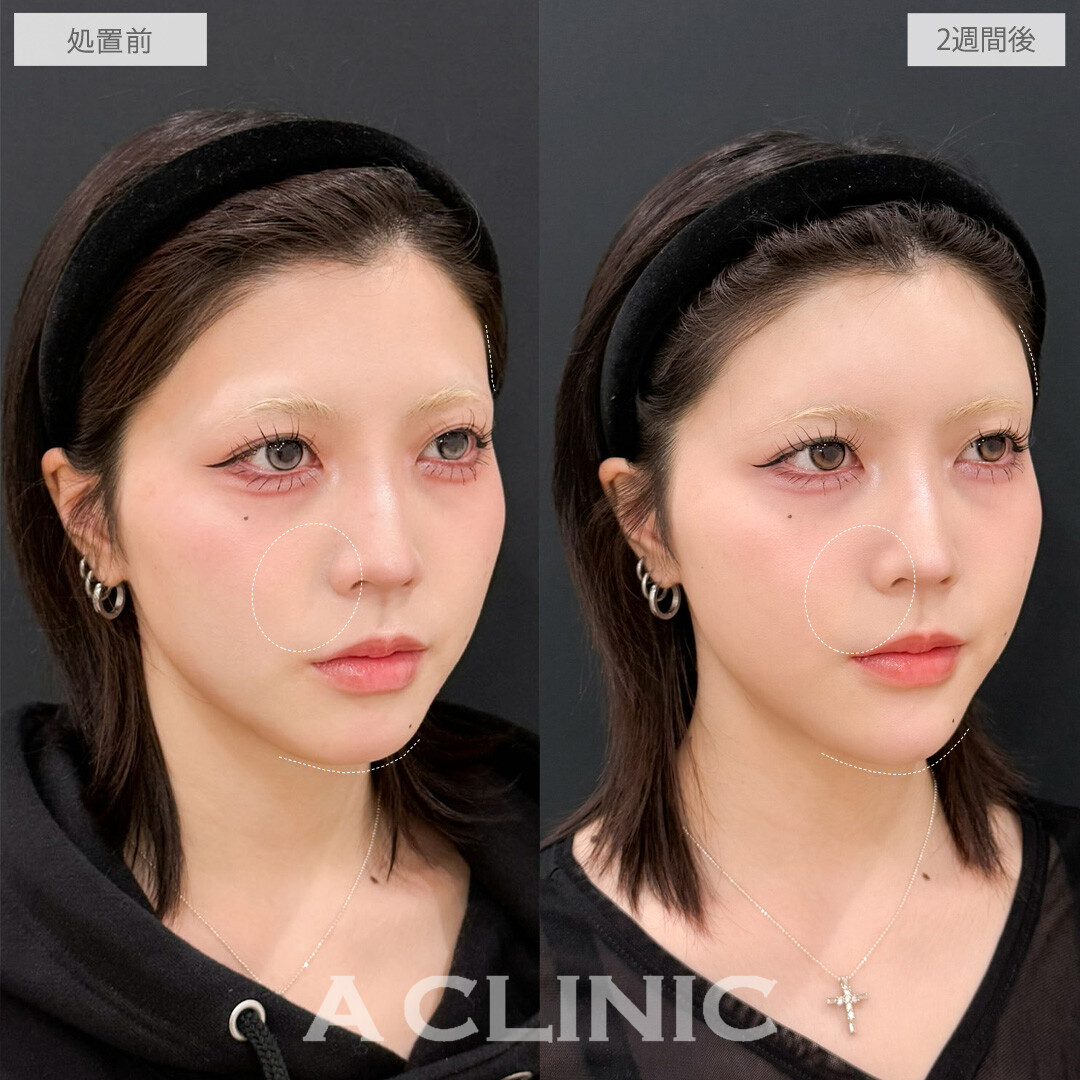ヒアルロン酸カスタマイズメニューで作る丸いおでこと黄金比Eラインで全方位無敵のお顔に！こちら処置前と2週間後の症例です(20代女性)