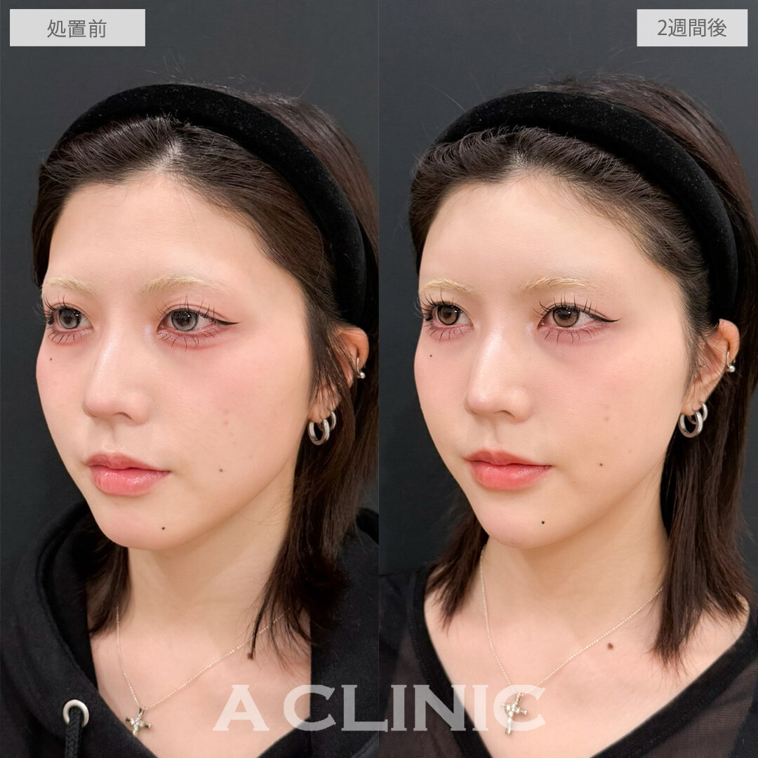 ヒアルロン酸カスタマイズメニューで作る丸いおでこと黄金比Eラインで全方位無敵のお顔に！こちら処置前と2週間後の症例です(20代女性)
