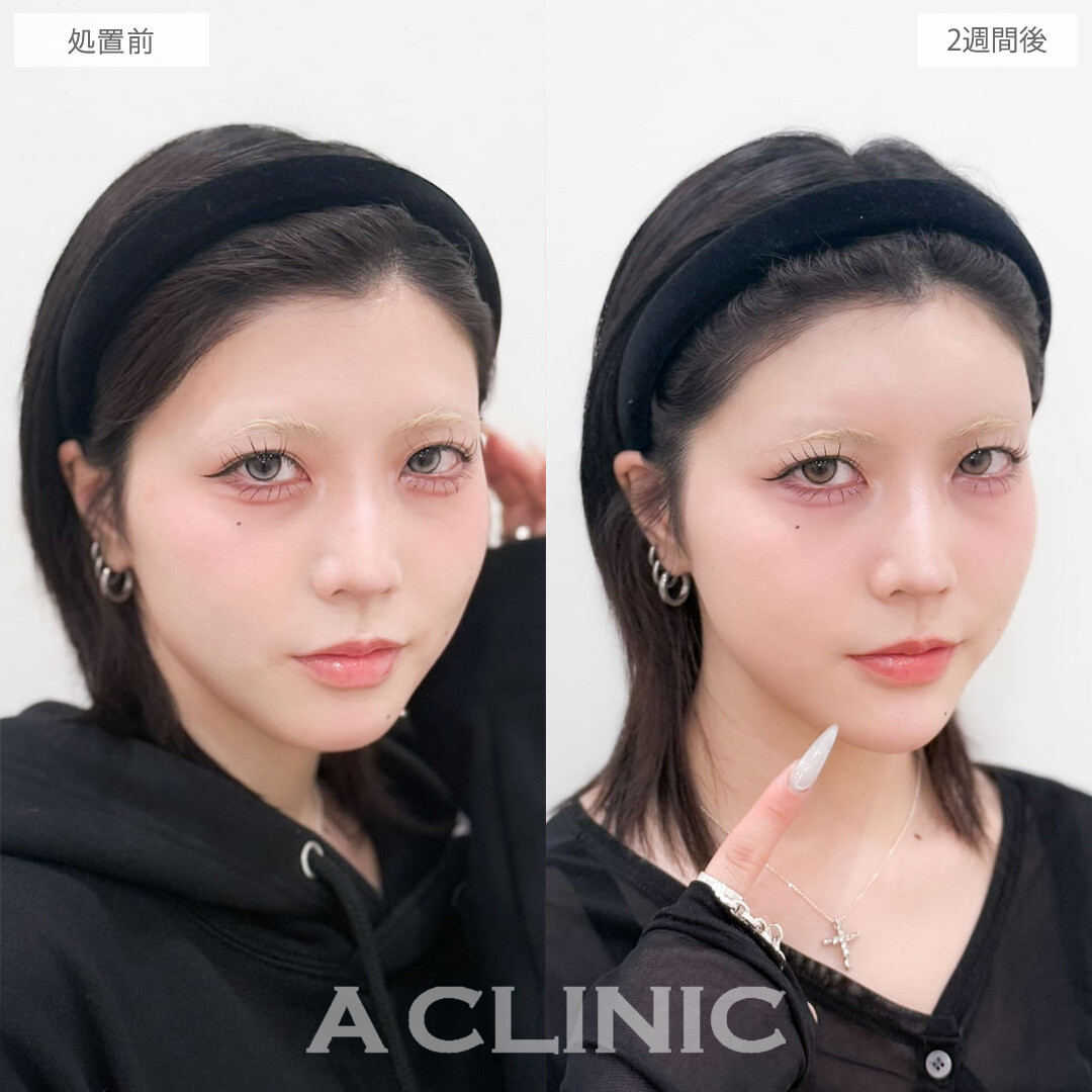 ヒアルロン酸カスタマイズメニューで作る丸いおでこと黄金比Eラインで全方位無敵のお顔に！こちら処置前と2週間後の症例です(20代女性)