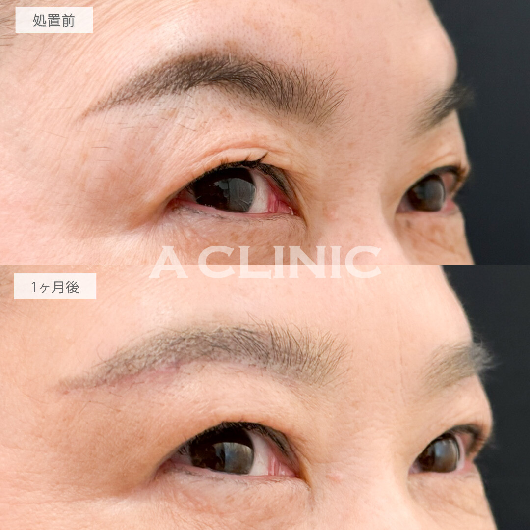 眉下リフトで瞼のしわが目立たなくなりました！処置前と1ヶ月後の症例です(60代女性)
