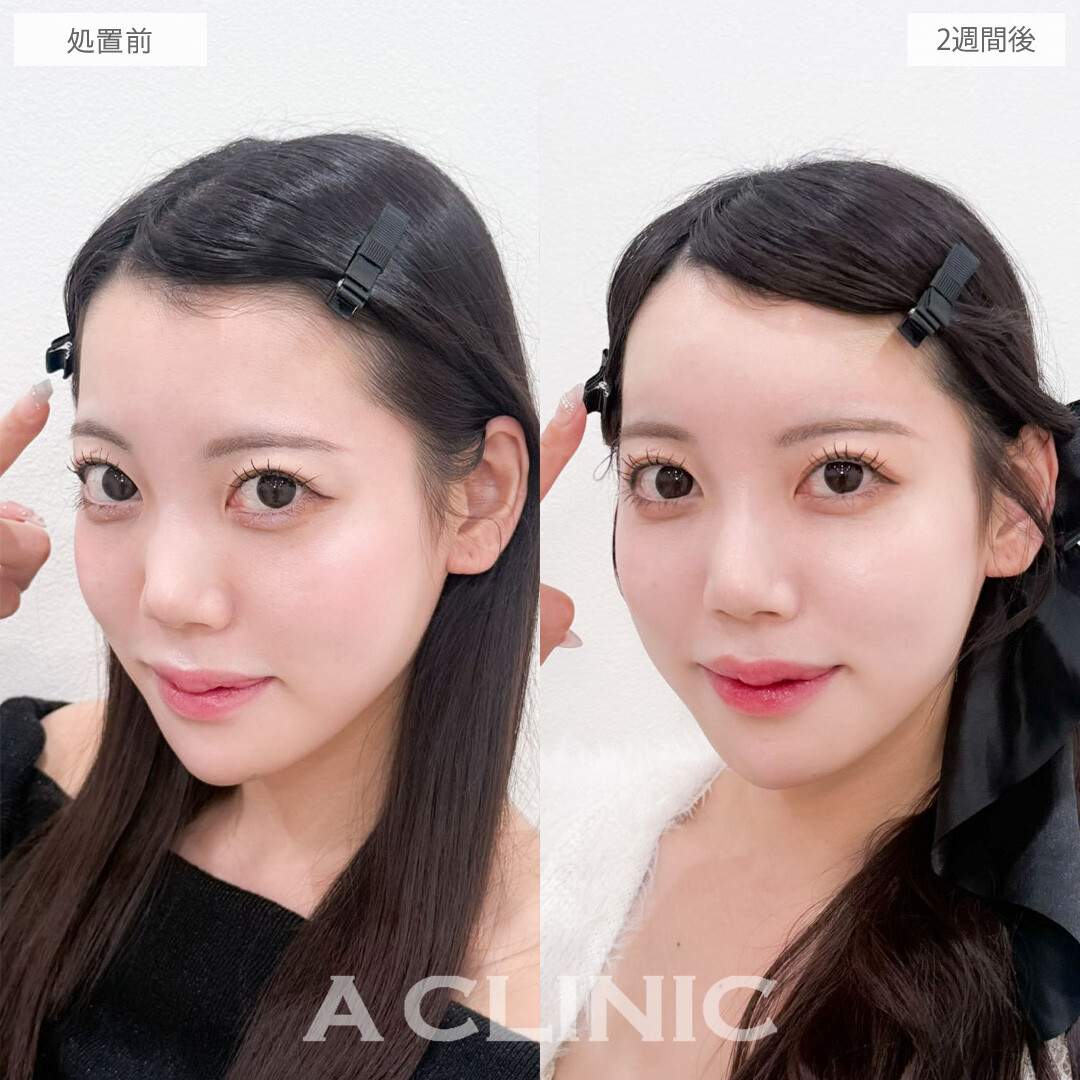 額出し(ヒアルロン酸注入)でつくる多幸感フェイス！こちら処置前と2週間後の症例です(20代女性)