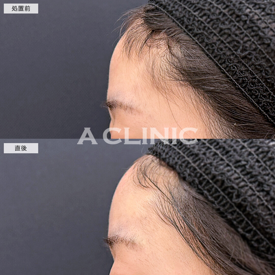 額出し、眉間深部、コメカミ形成(ヒアルロン酸注入)で丸いバブみのあるおでこが完成！処置前と直後の症例です(10代女性)