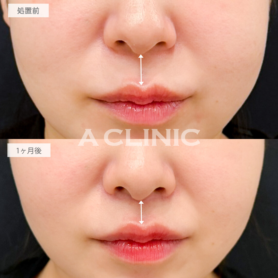 人中短縮術で垢抜けと若見え効果を一気に実感！処置前と1ヶ月後の症例です(30代女性)