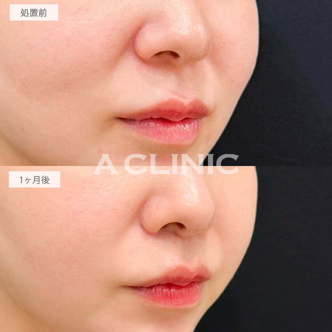 人中短縮術で垢抜けと若見え効果を一気に実感！処置前と1ヶ月後の症例です(30代女性)