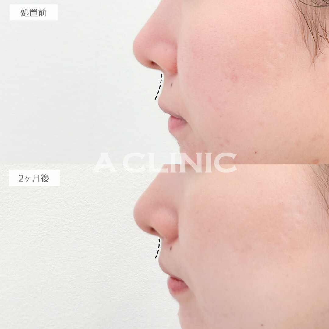人中短縮術でお顔全体の印象も大きく変わります！処置前と2ヶ月後の症例です(20代女性)