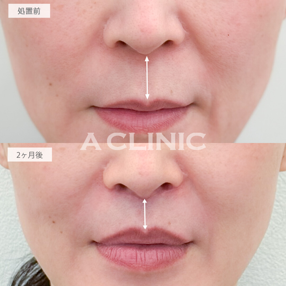 人中短縮術で老け顔に見えやすい長い人中も短くして若々しい口元へ！処置前と2ヶ月後の症例です(50代女性)
